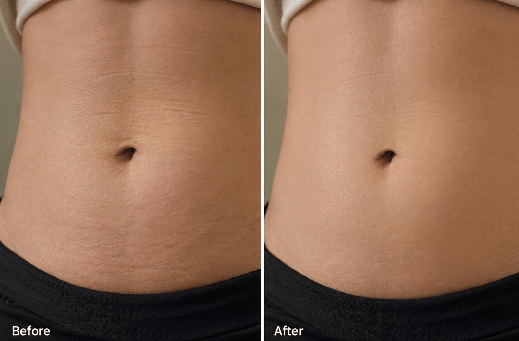 Vyral Belly Cream